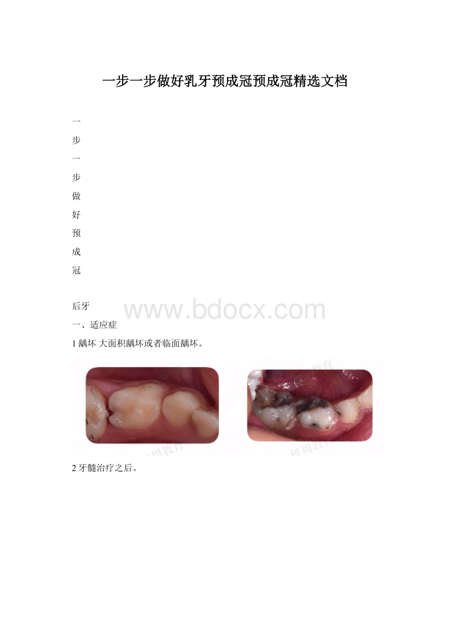 一步一步做好乳牙预成冠预成冠精选文档Word格式.docx_第1页