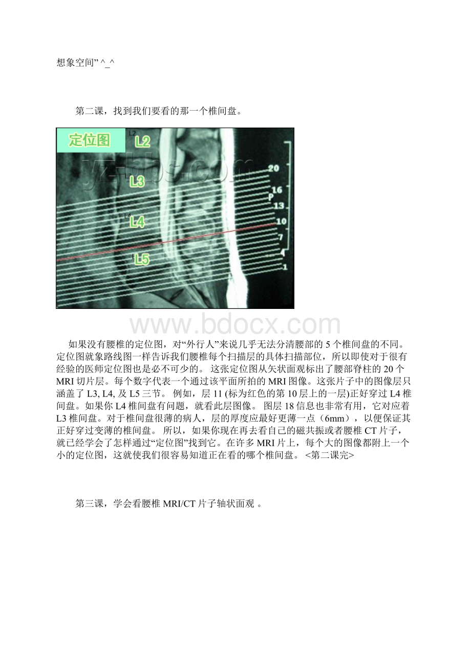 腰椎间盘突出Word格式文档下载.docx_第2页