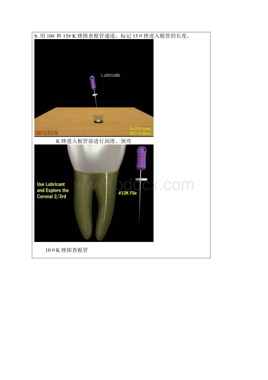 根管预备操作流程.docx_第2页