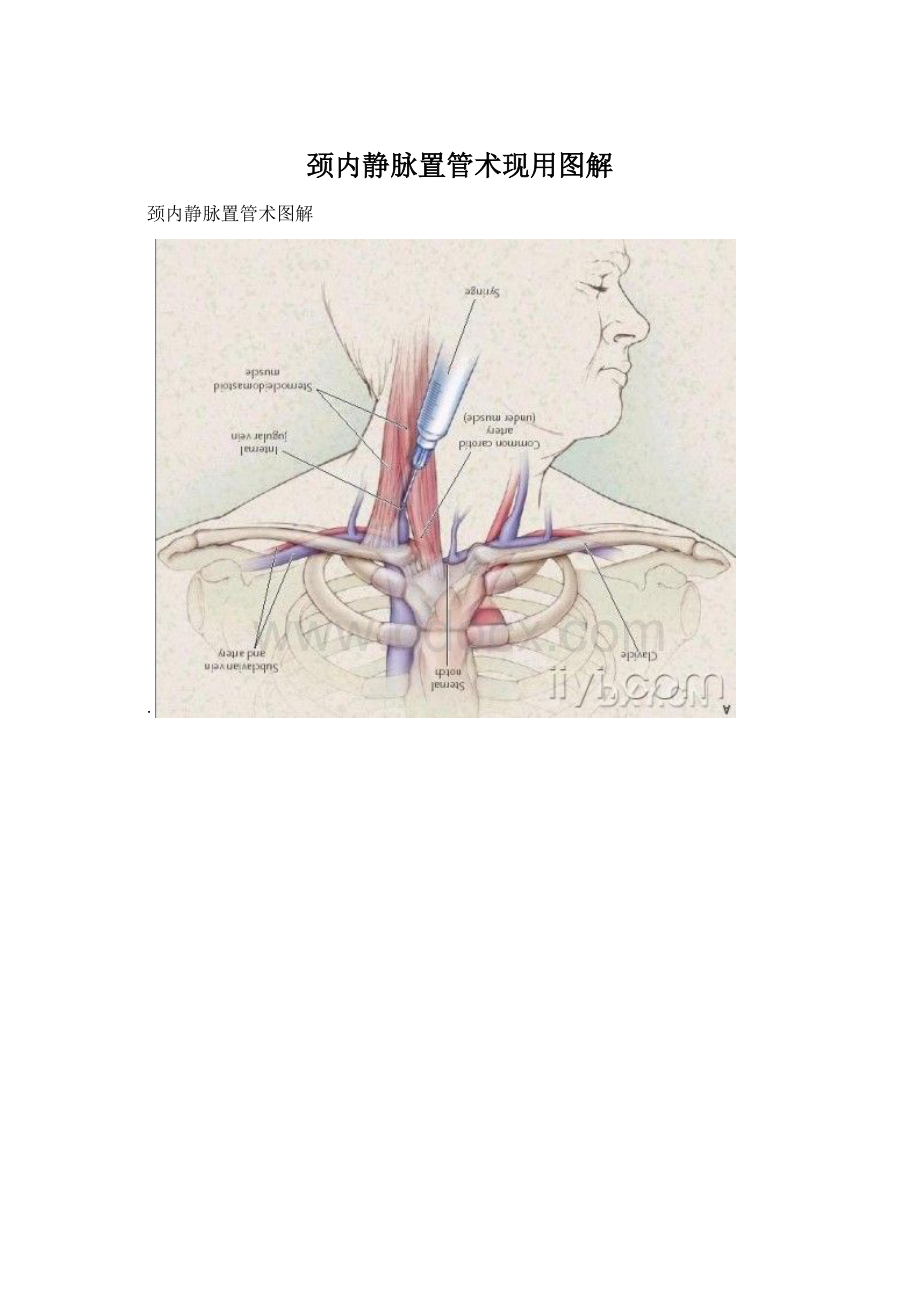 颈内静脉置管术现用图解.docx_第1页