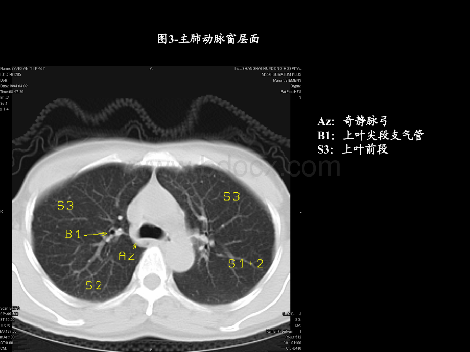 胸部CT的影像学表现.ppt_第3页