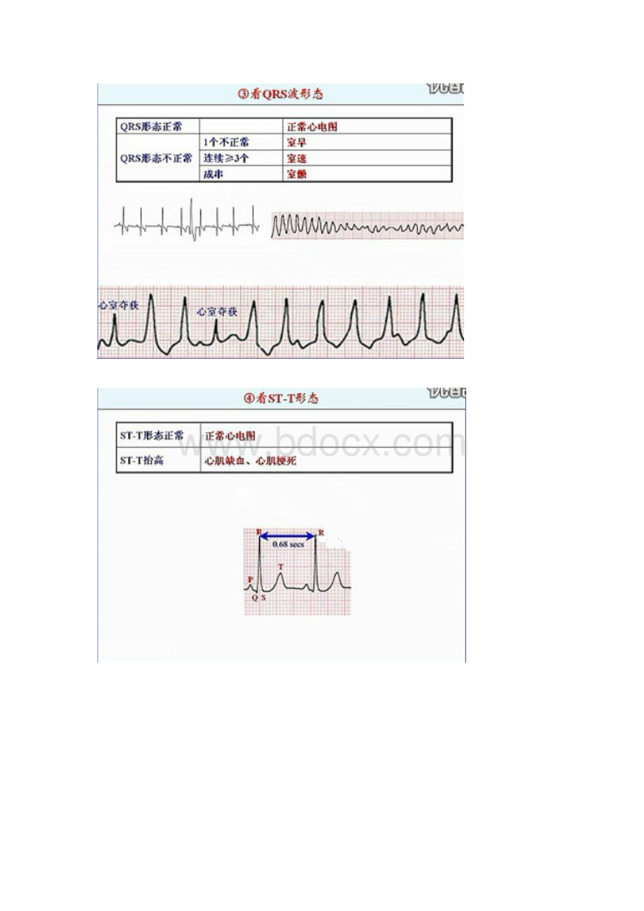 心电图总结文档格式.doc_第3页