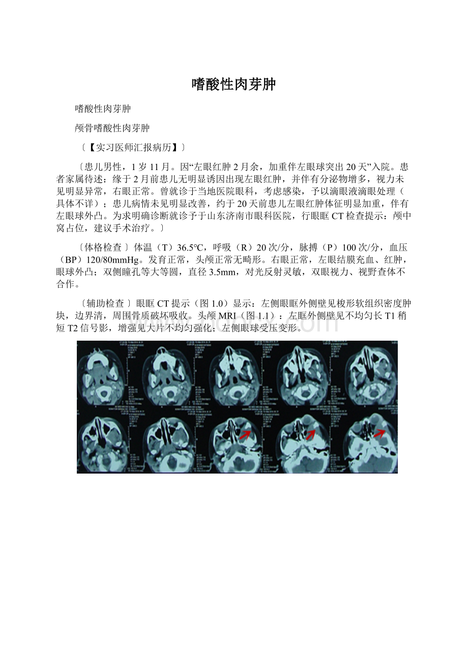 嗜酸性肉芽肿Word格式文档下载.docx