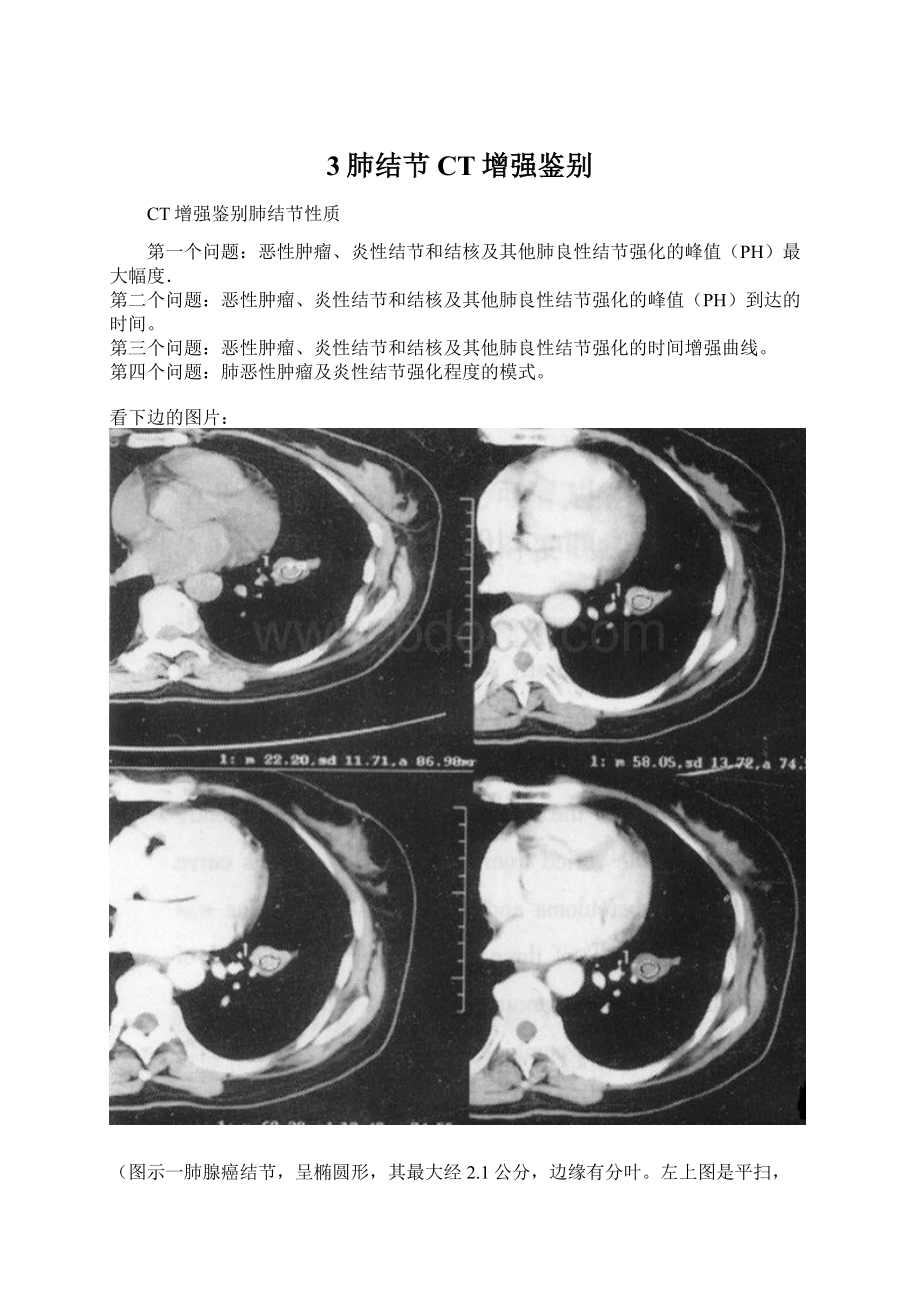 3肺结节CT增强鉴别Word文件下载.docx