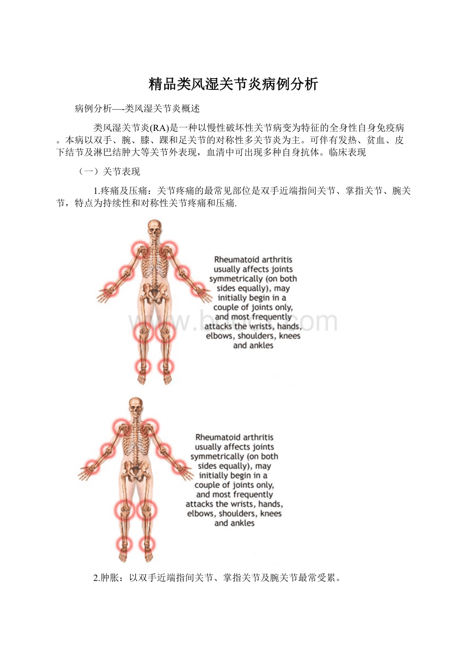 精品类风湿关节炎病例分析.docx_第1页