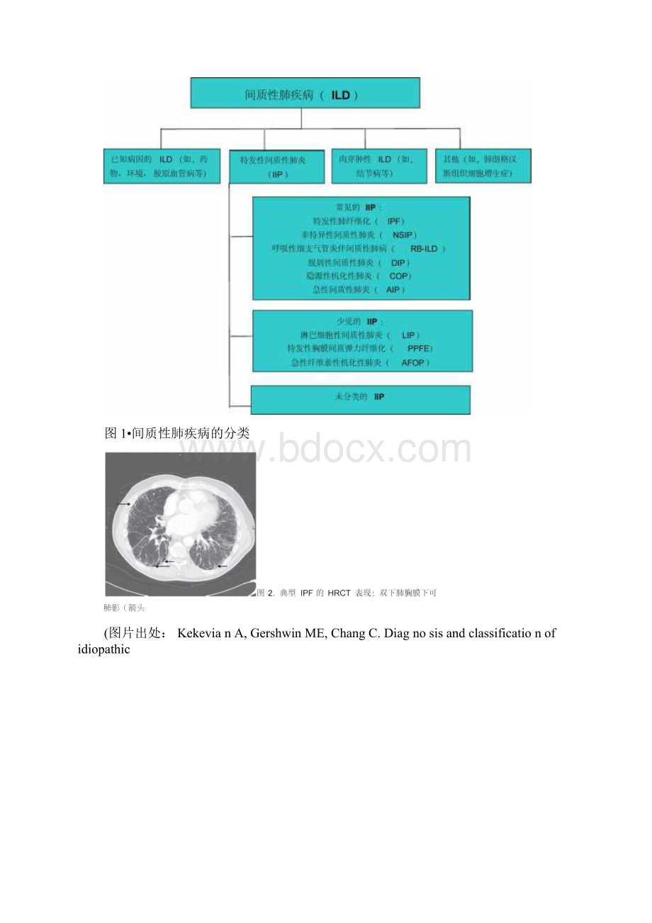 间质性肺病进展文档格式.docx_第3页