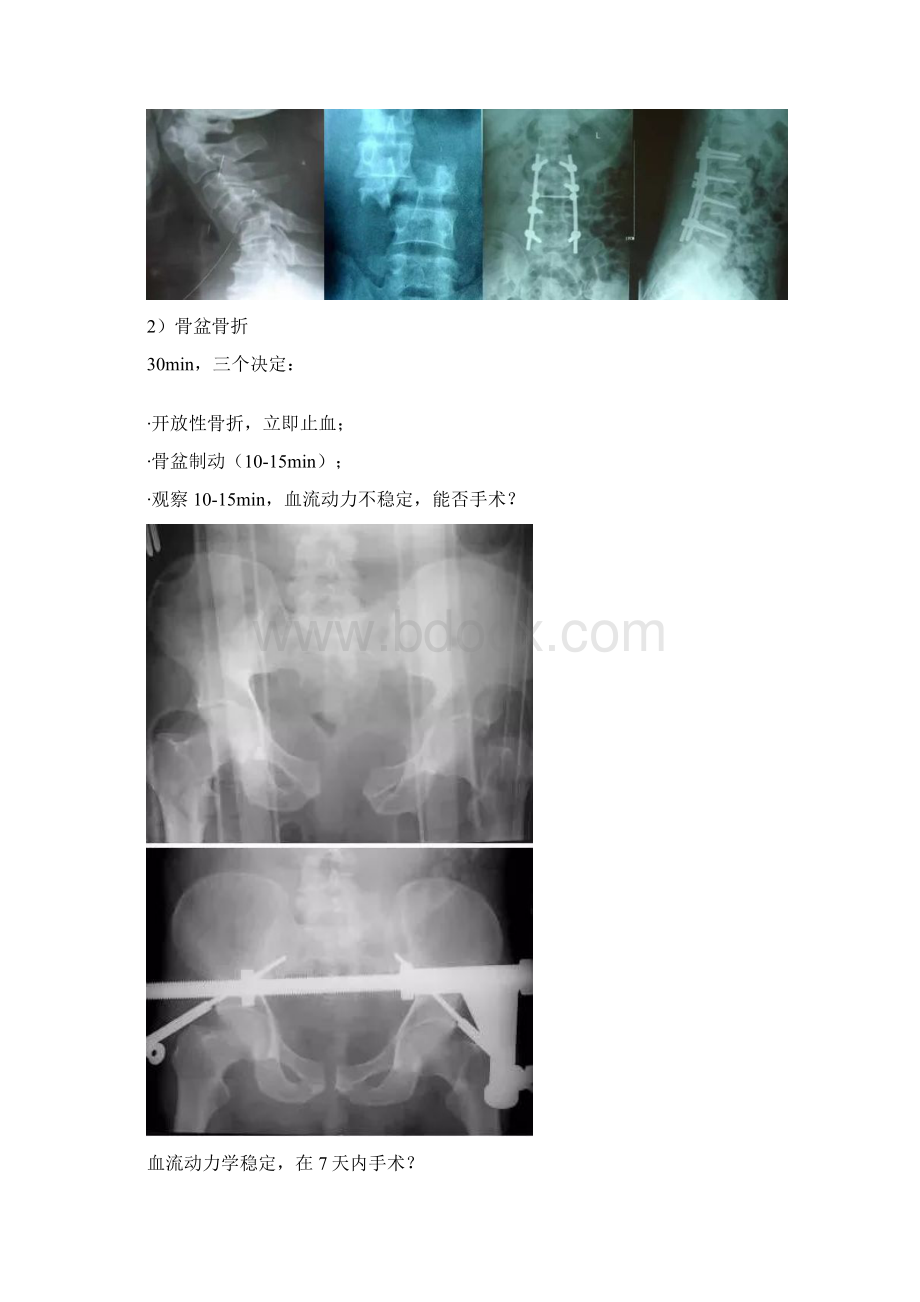 各部位骨折的最佳手术时机.docx_第3页