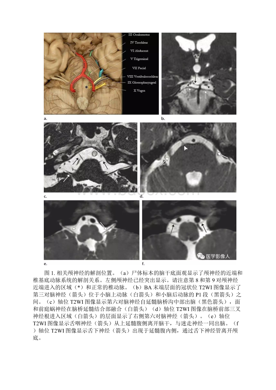 基底动脉延长扩张症知识分享.docx_第3页