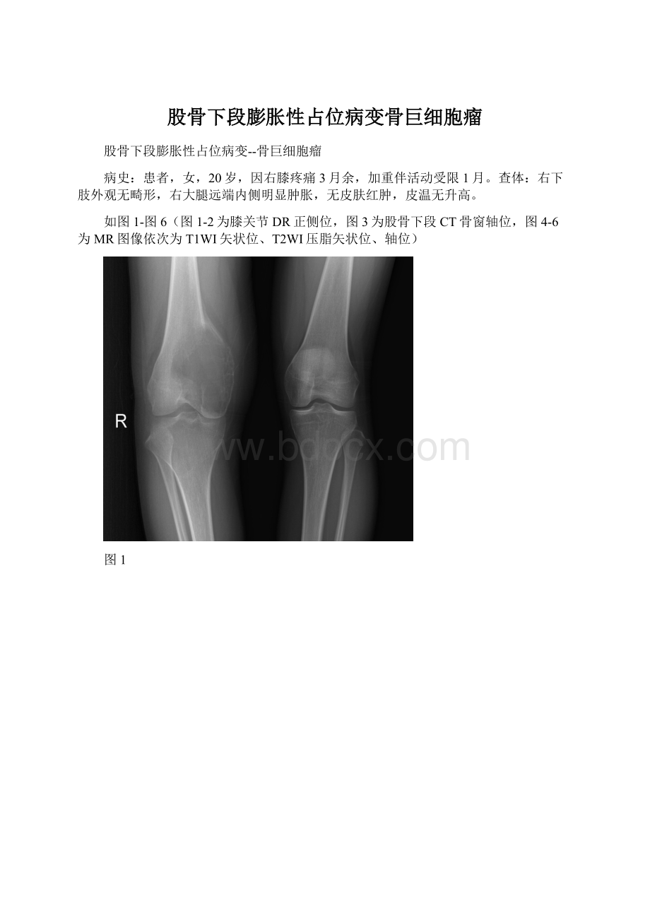 股骨下段膨胀性占位病变骨巨细胞瘤Word格式文档下载.docx_第1页