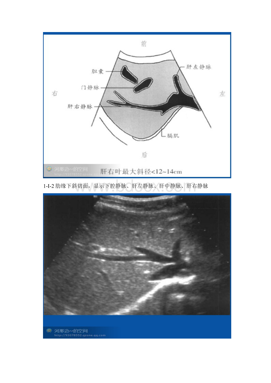 肝脏超声20个切面Word下载.docx_第2页