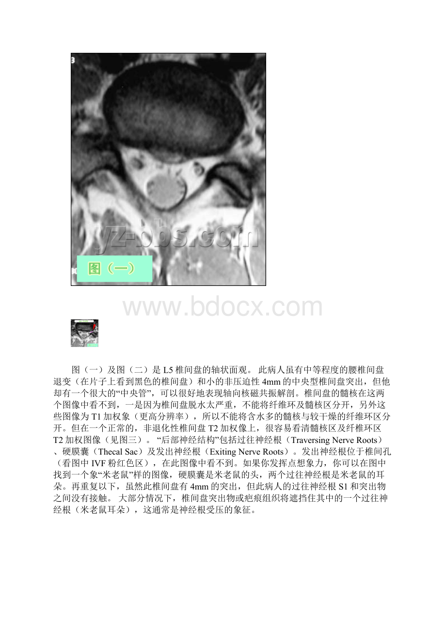 教你如何能看腰椎间盘突出CT和MR片.docx_第3页