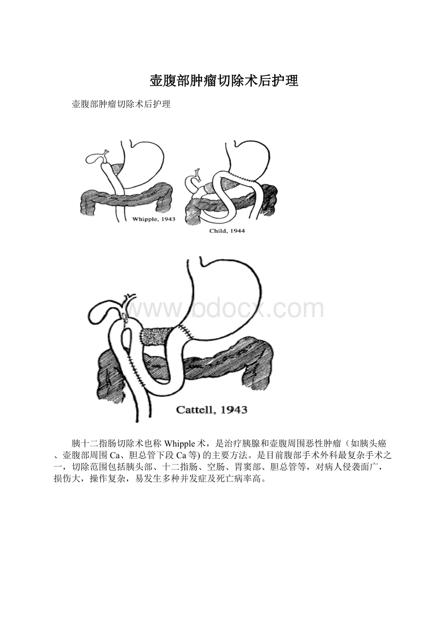 壶腹部肿瘤切除术后护理文档格式.docx_第1页