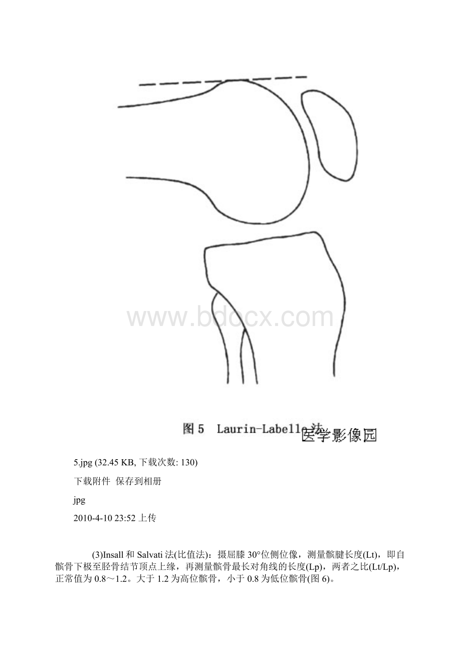 髌骨不稳的判断.docx_第3页