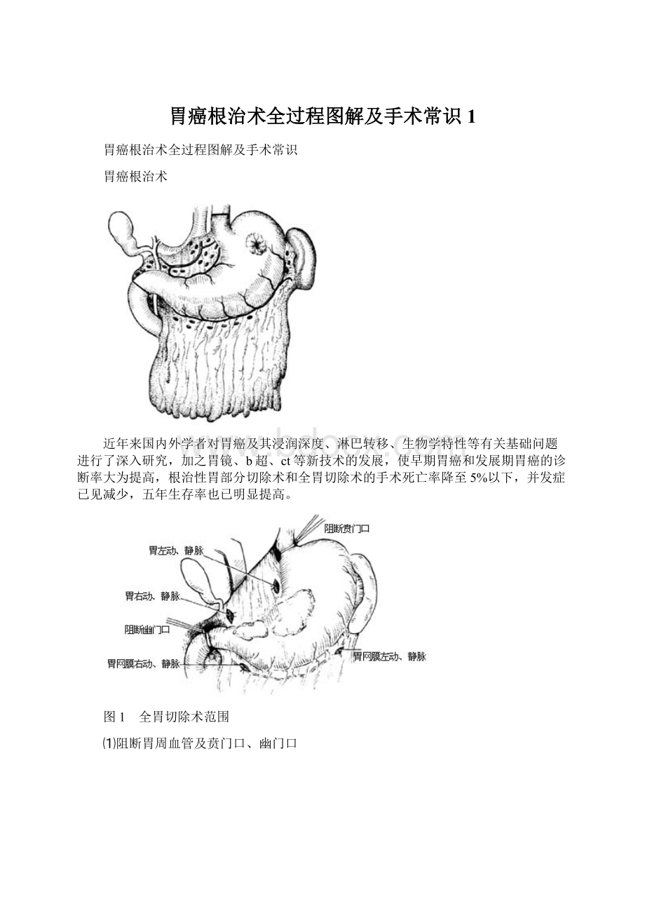 胃癌根治术全过程图解及手术常识1Word文档格式.docx_第1页