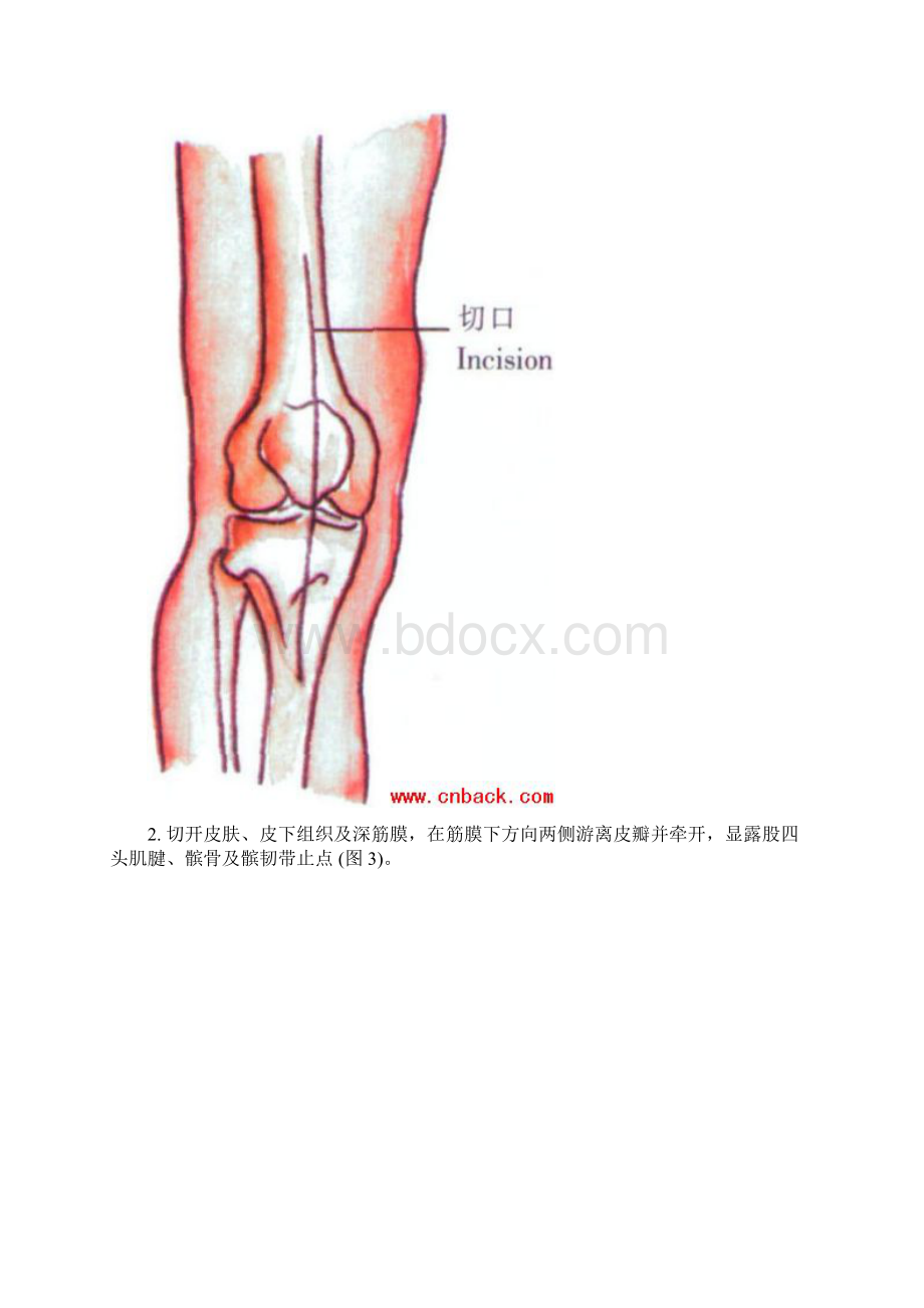 人工膝关节置换手术步骤全解.docx_第3页