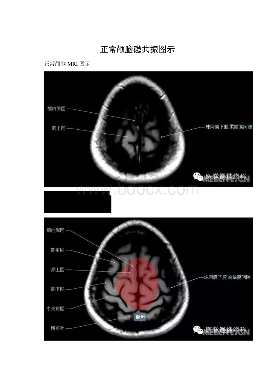 正常颅脑磁共振图示.docx
