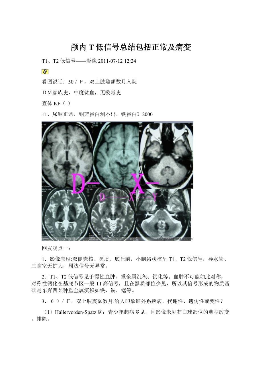 颅内T低信号总结包括正常及病变.docx