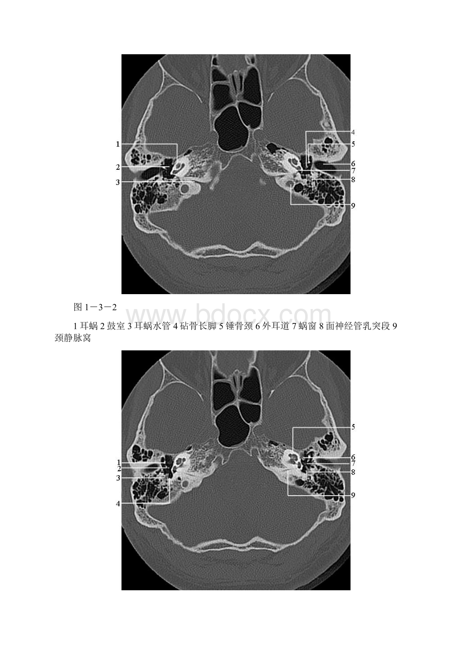 颞骨正常CT解剖.docx_第2页