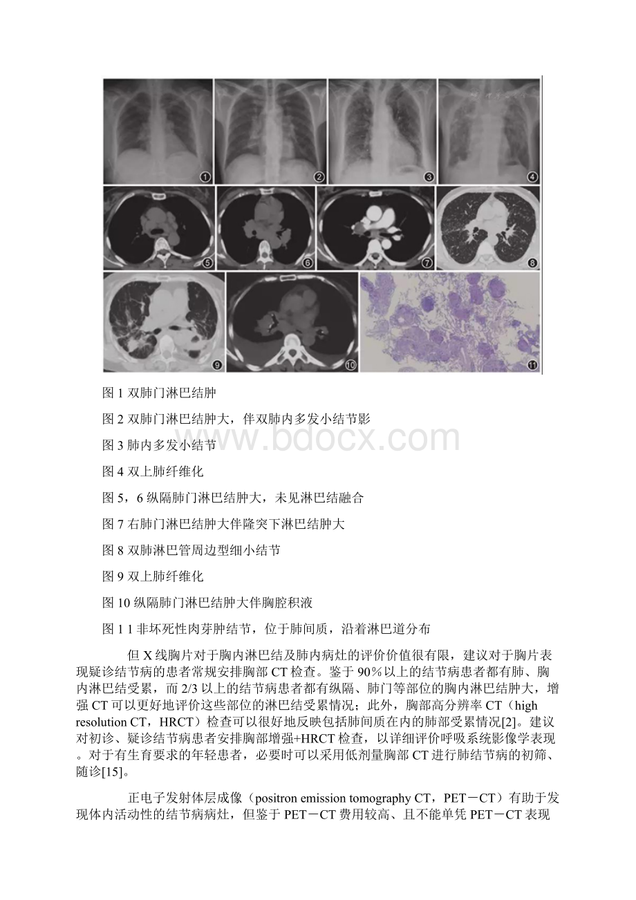 中国肺结节病诊断和治疗专家共识完整版Word文档格式.docx_第3页