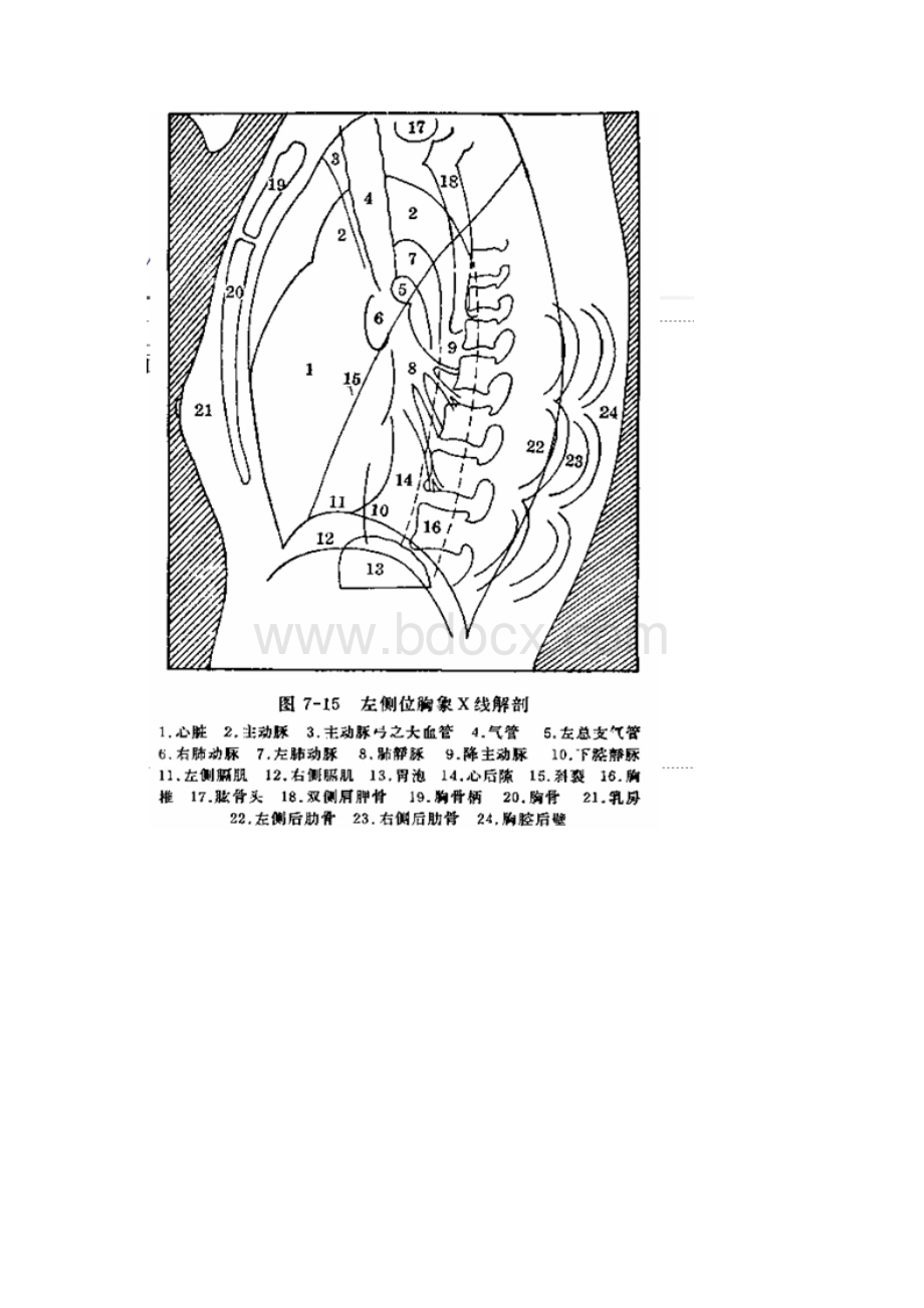 阅读胸片基础Word下载.docx_第3页