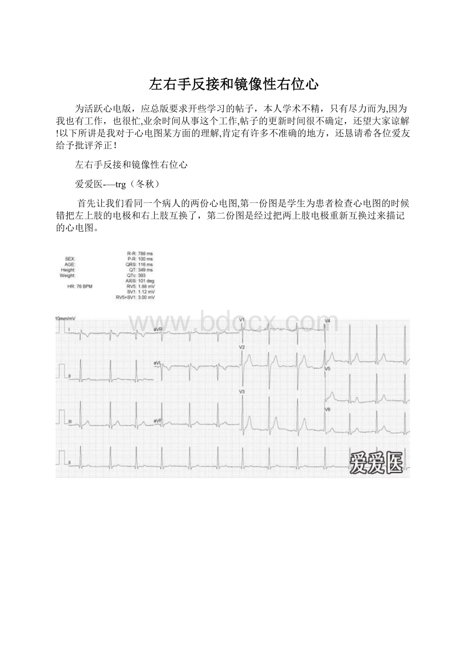 左右手反接和镜像性右位心.docx_第1页