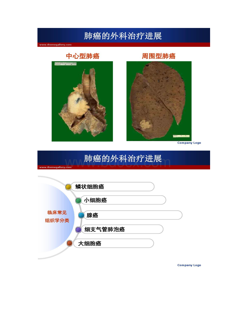 肺癌的外科治疗进展汇总Word下载.docx_第3页