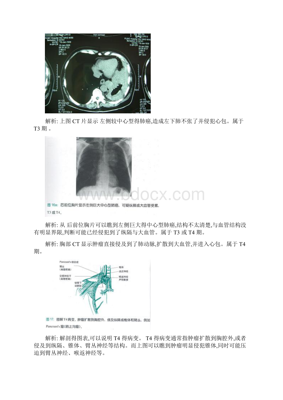 肺癌分期及预后Word格式文档下载.docx_第3页