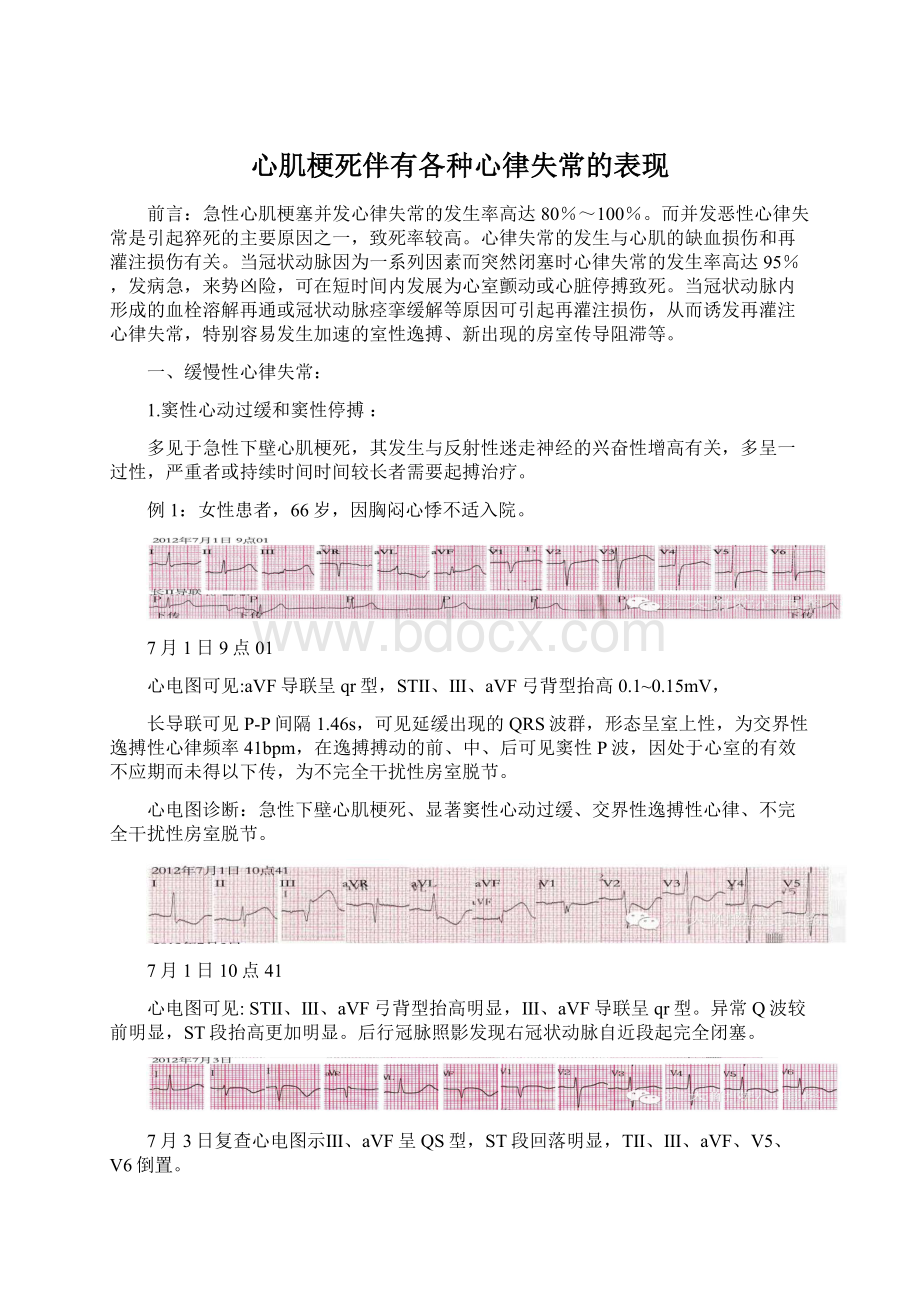 心肌梗死伴有各种心律失常的表现Word文件下载.docx_第1页