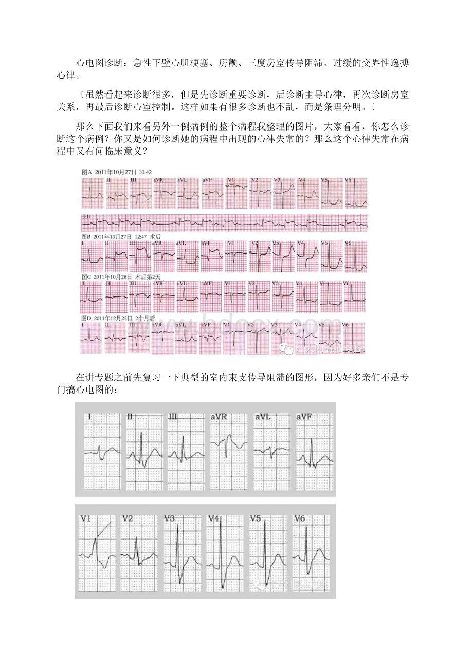 心肌梗死伴有各种心律失常的表现Word文件下载.docx_第3页