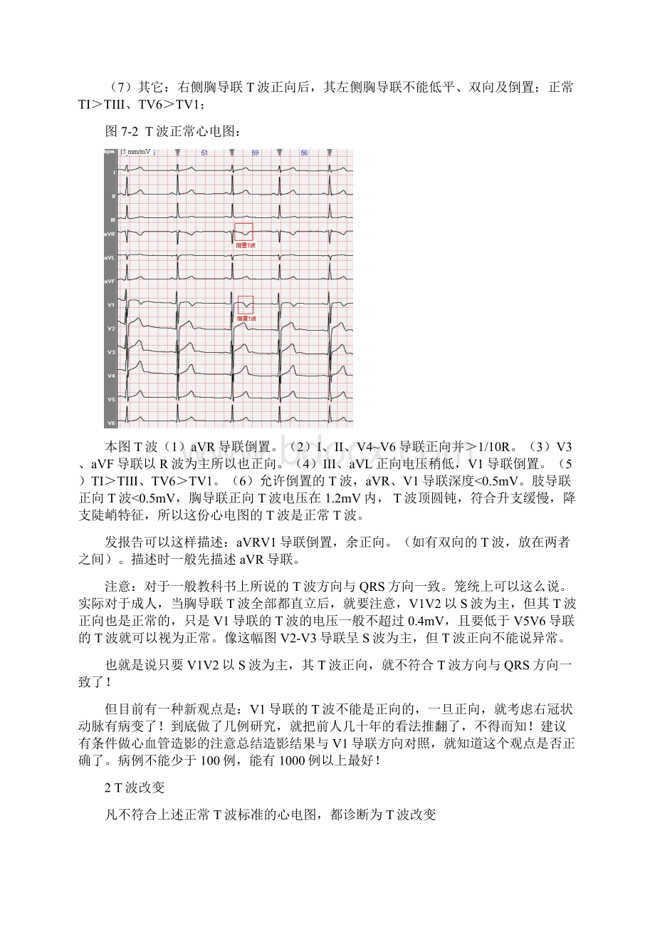 另类心电图学讲义10T波分析.docx_第3页