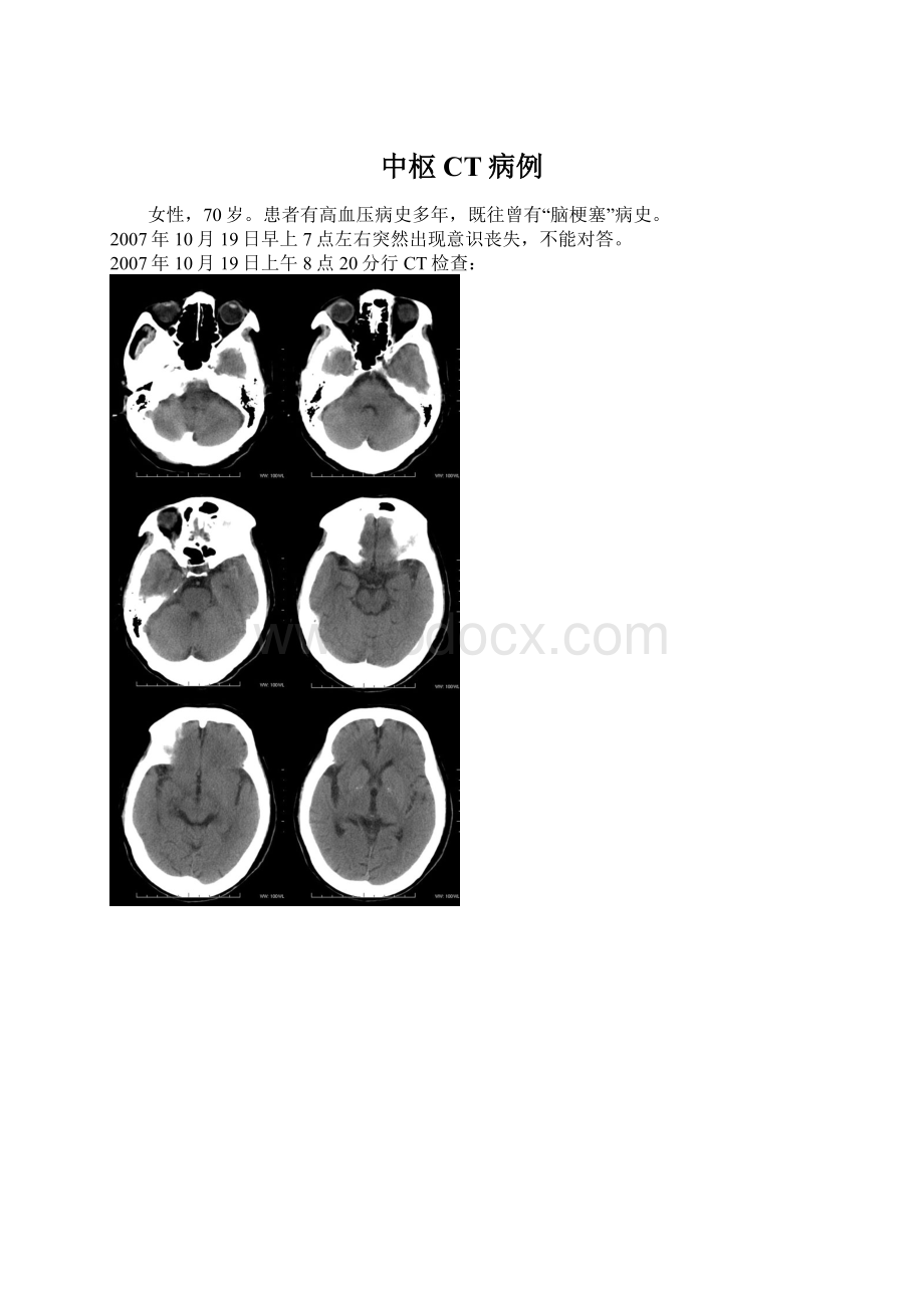 中枢CT病例.docx_第1页