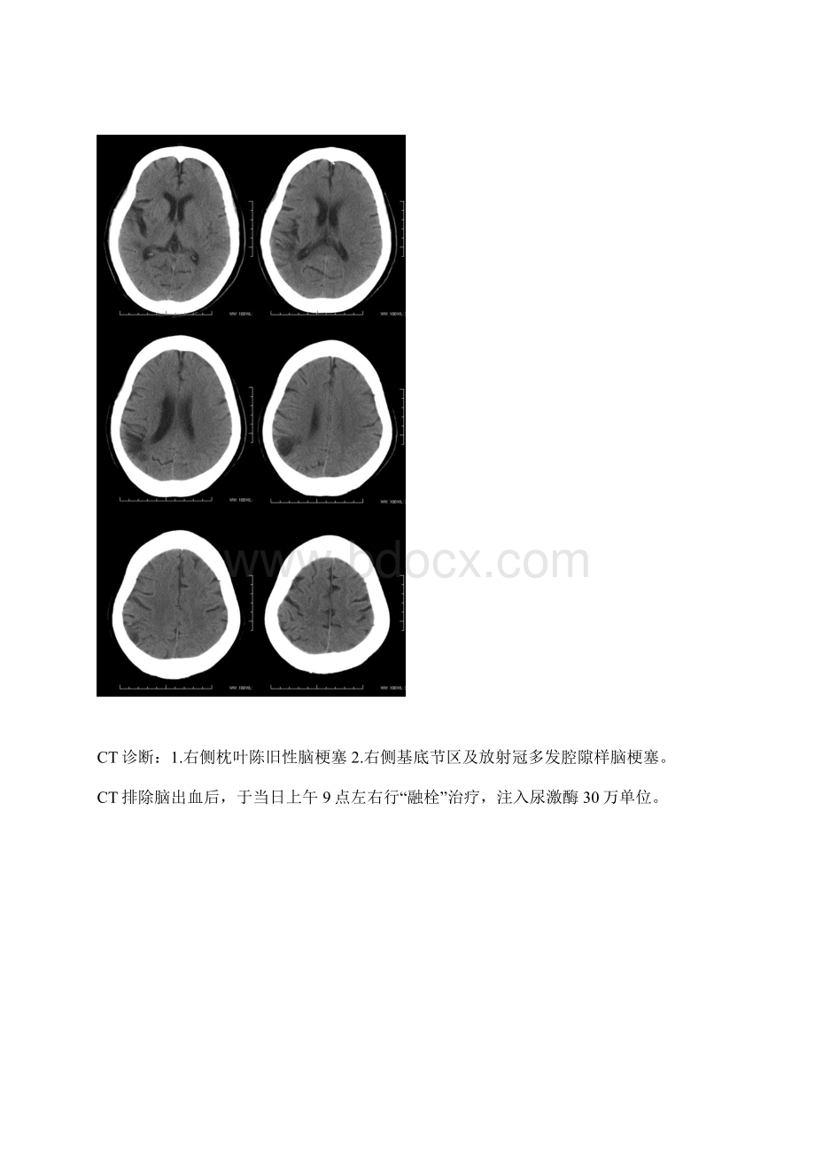 中枢CT病例.docx_第2页