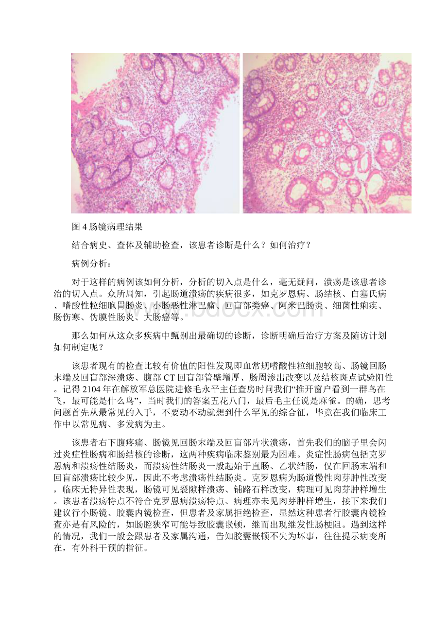 嗜酸性粒细胞胃肠炎.docx_第3页