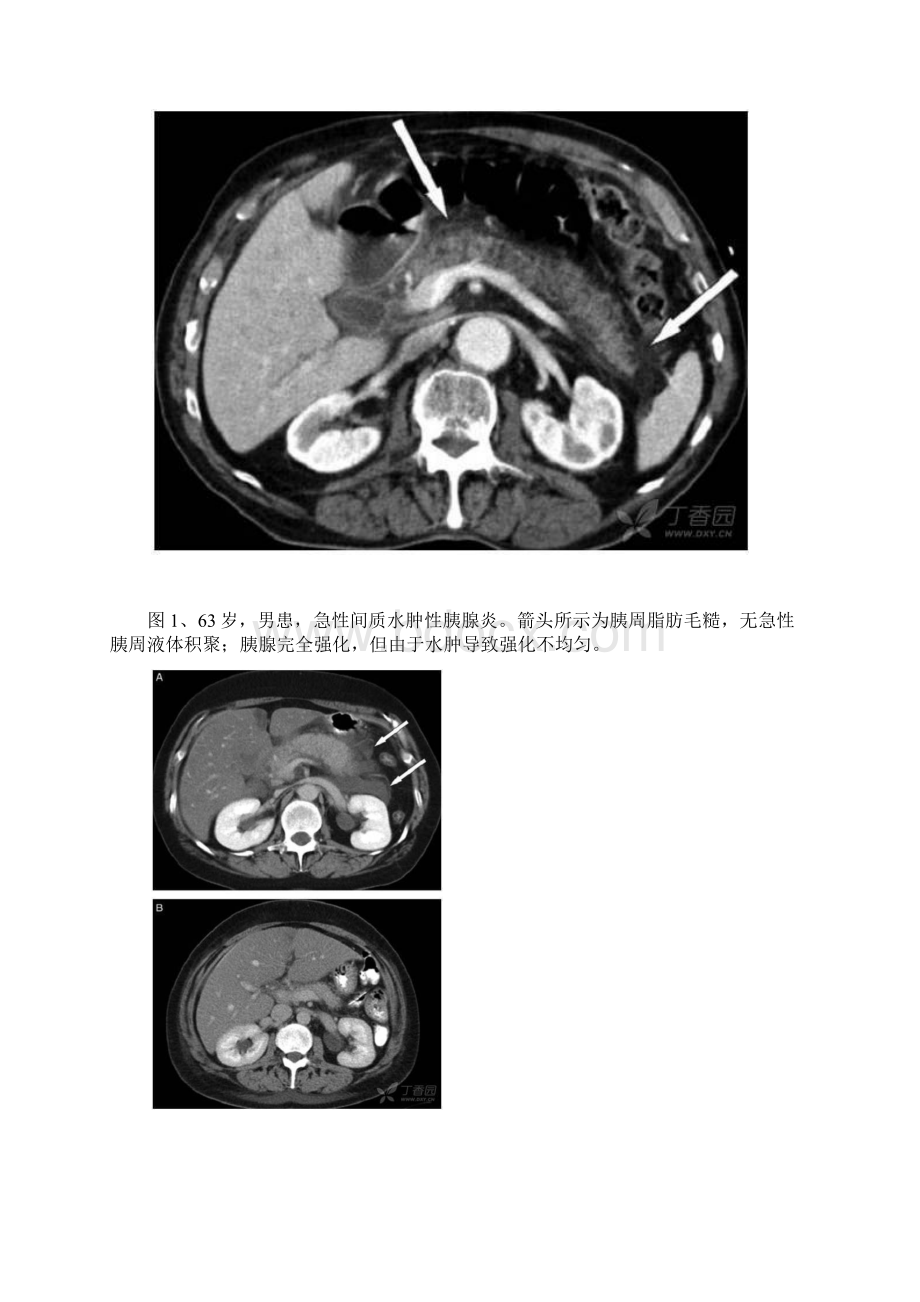 急性胰腺炎分类和定义地国际共识文档格式.docx_第3页