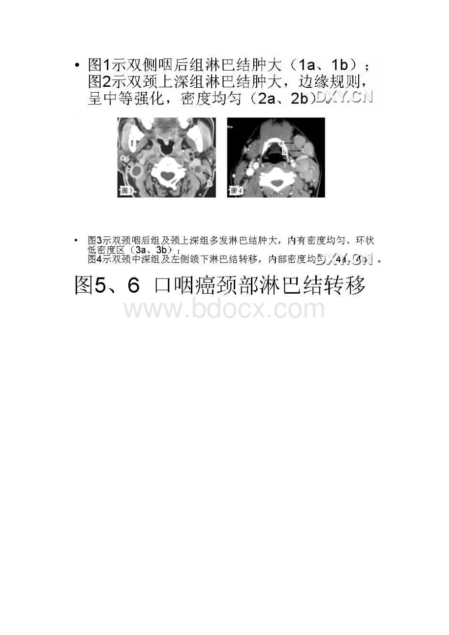 头颈部淋巴结肿大的诊断要点.docx_第2页