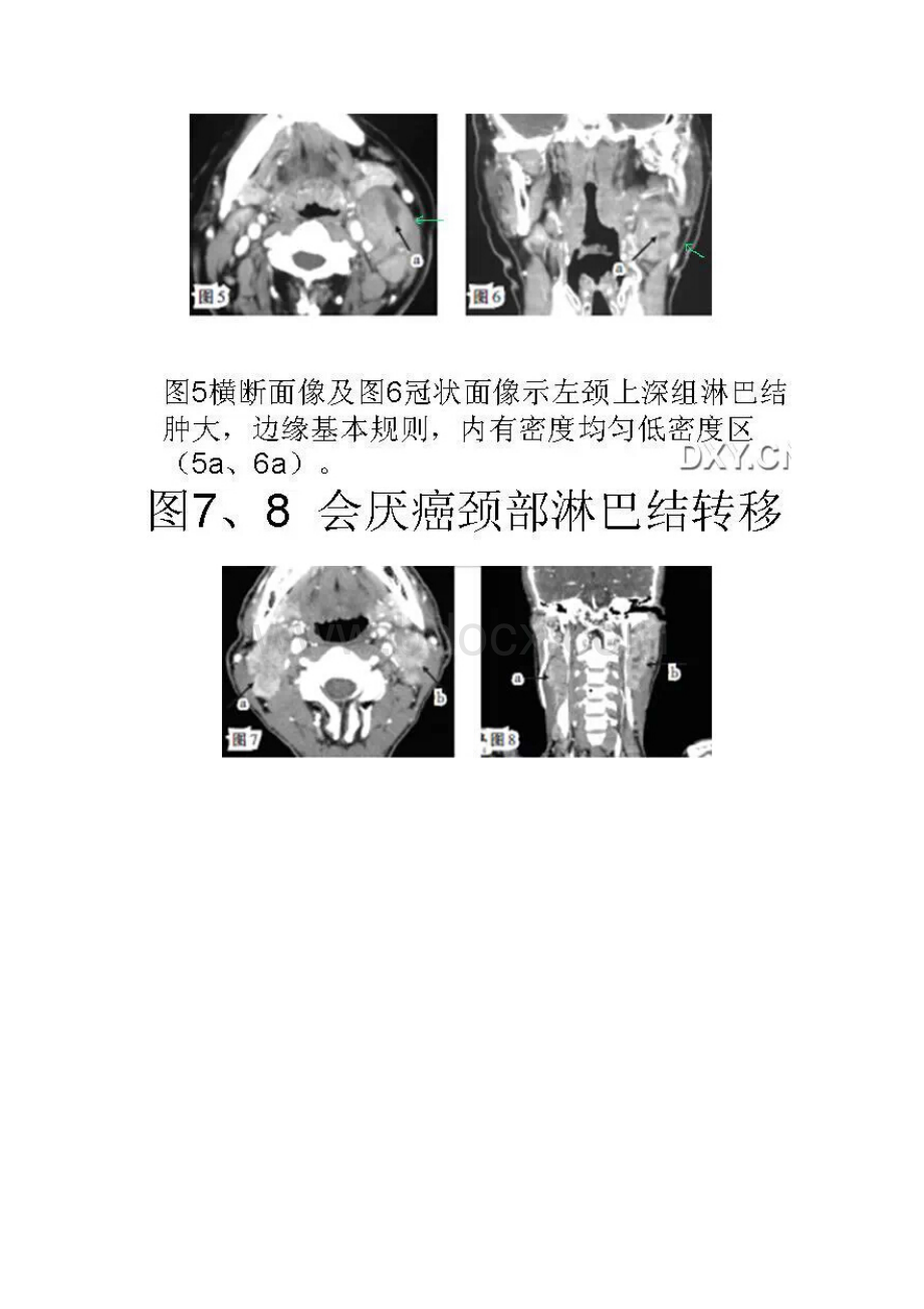 头颈部淋巴结肿大的诊断要点.docx_第3页