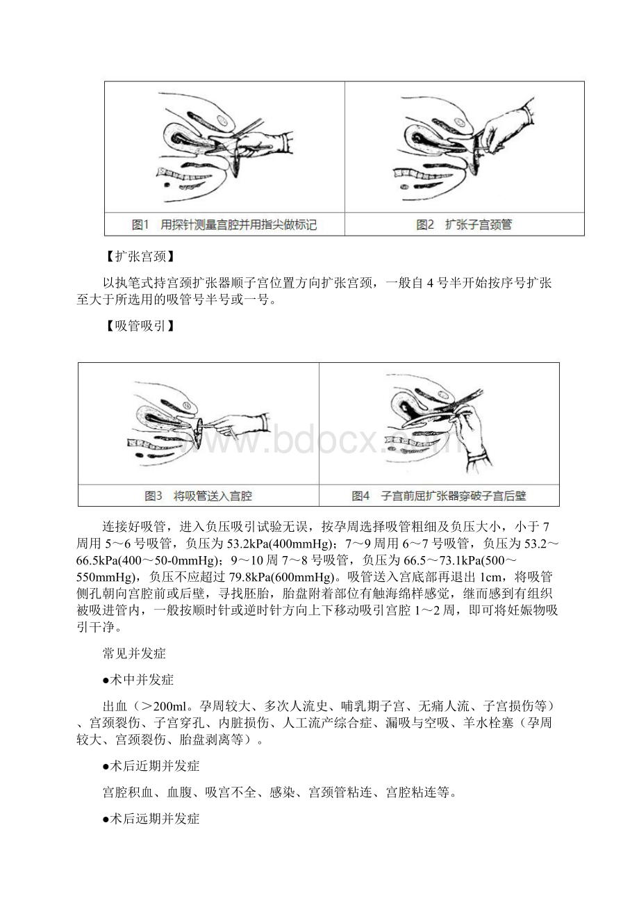 五常见妇科小手术操作要点及注意事项讲课稿.docx_第2页