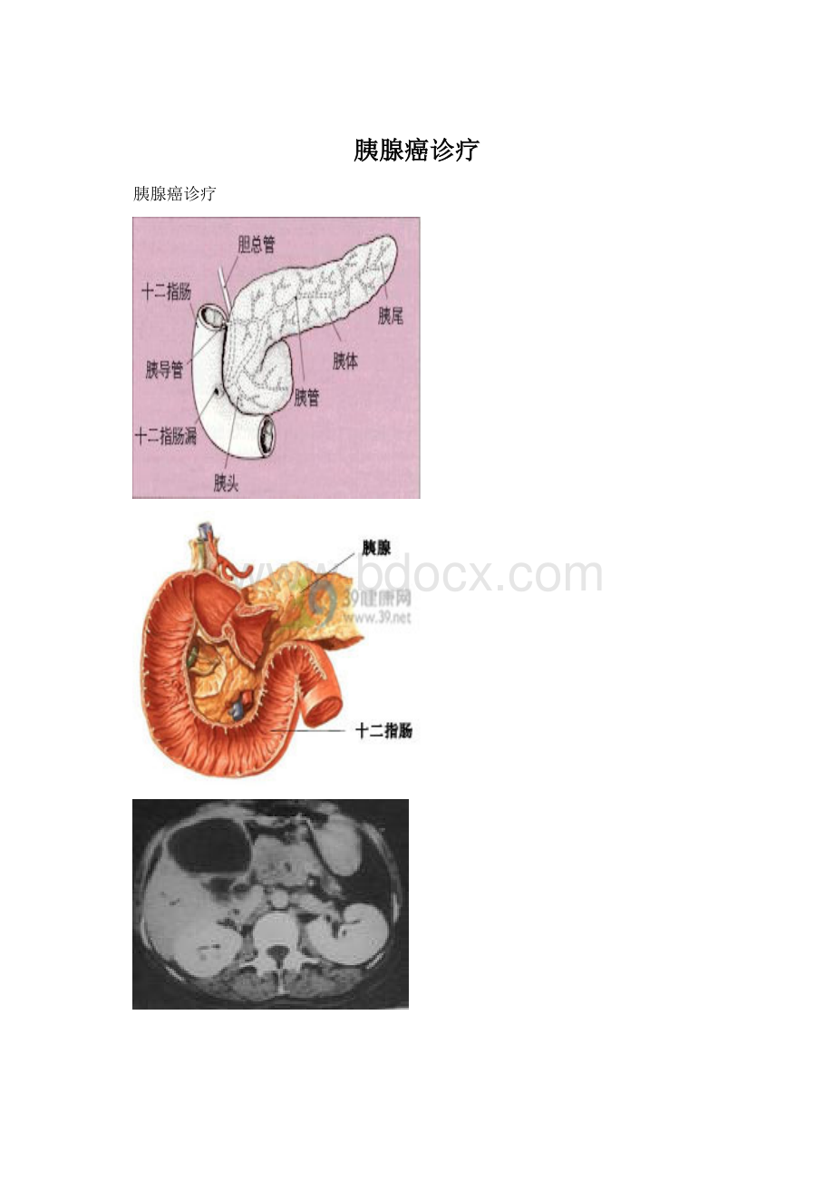 胰腺癌诊疗.docx_第1页