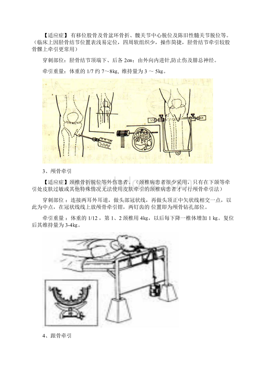 骨科的地牵引术常用方式及要点详解.docx_第3页