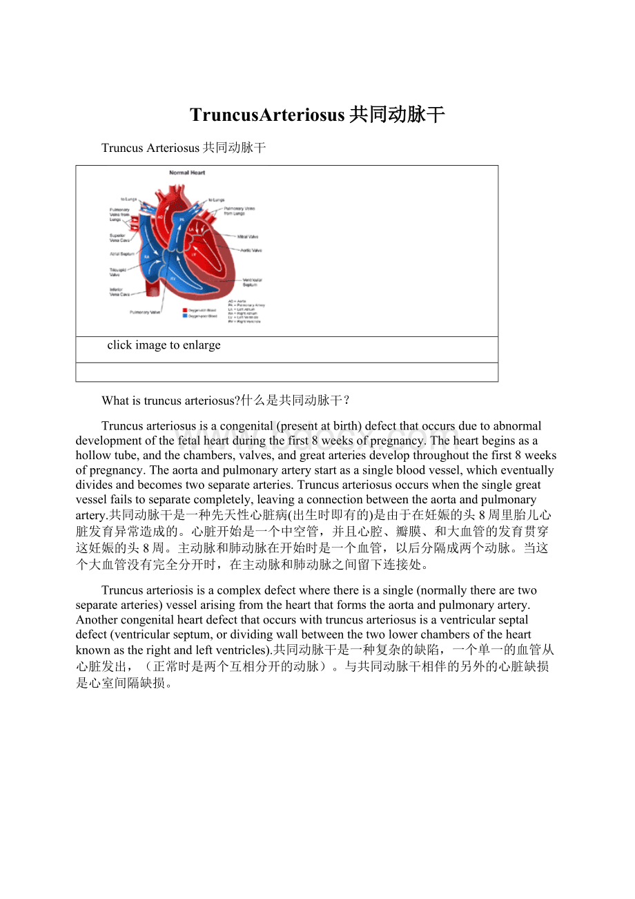 TruncusArteriosus共同动脉干.docx_第1页