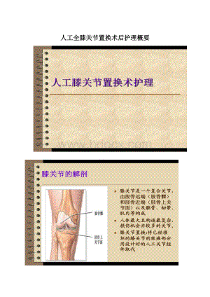 人工全膝关节置换术后护理概要Word下载.docx