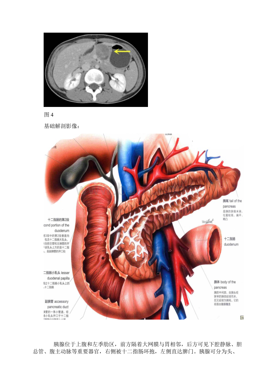 胰体囊实混合性占位病变实性假乳头状瘤.docx_第2页