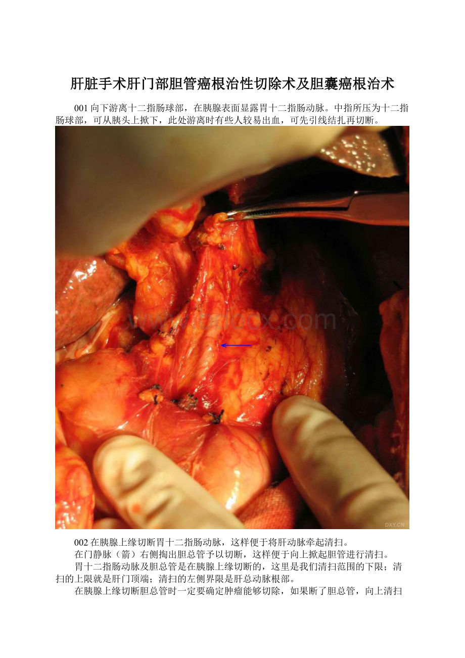 肝脏手术肝门部胆管癌根治性切除术及胆囊癌根治术.docx