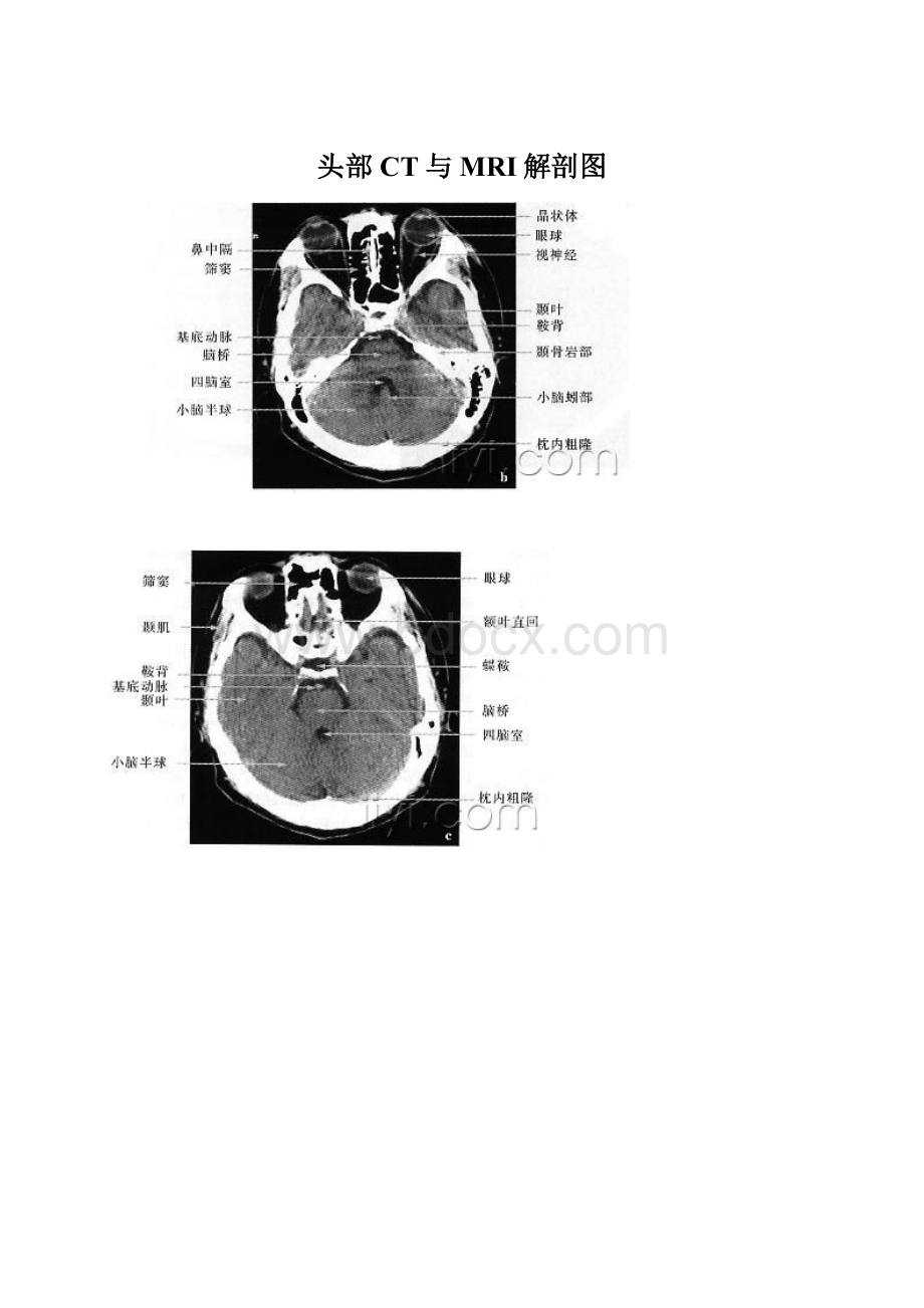 头部CT与MRI解剖图Word格式文档下载.docx_第1页