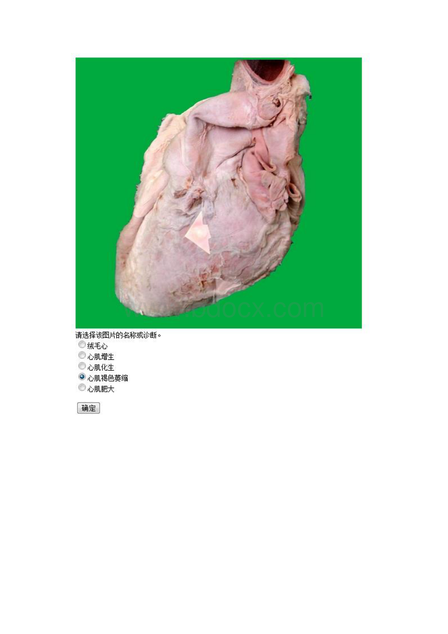 中国医科大学《病理学本科》 实践考试题满分答案.docx_第2页