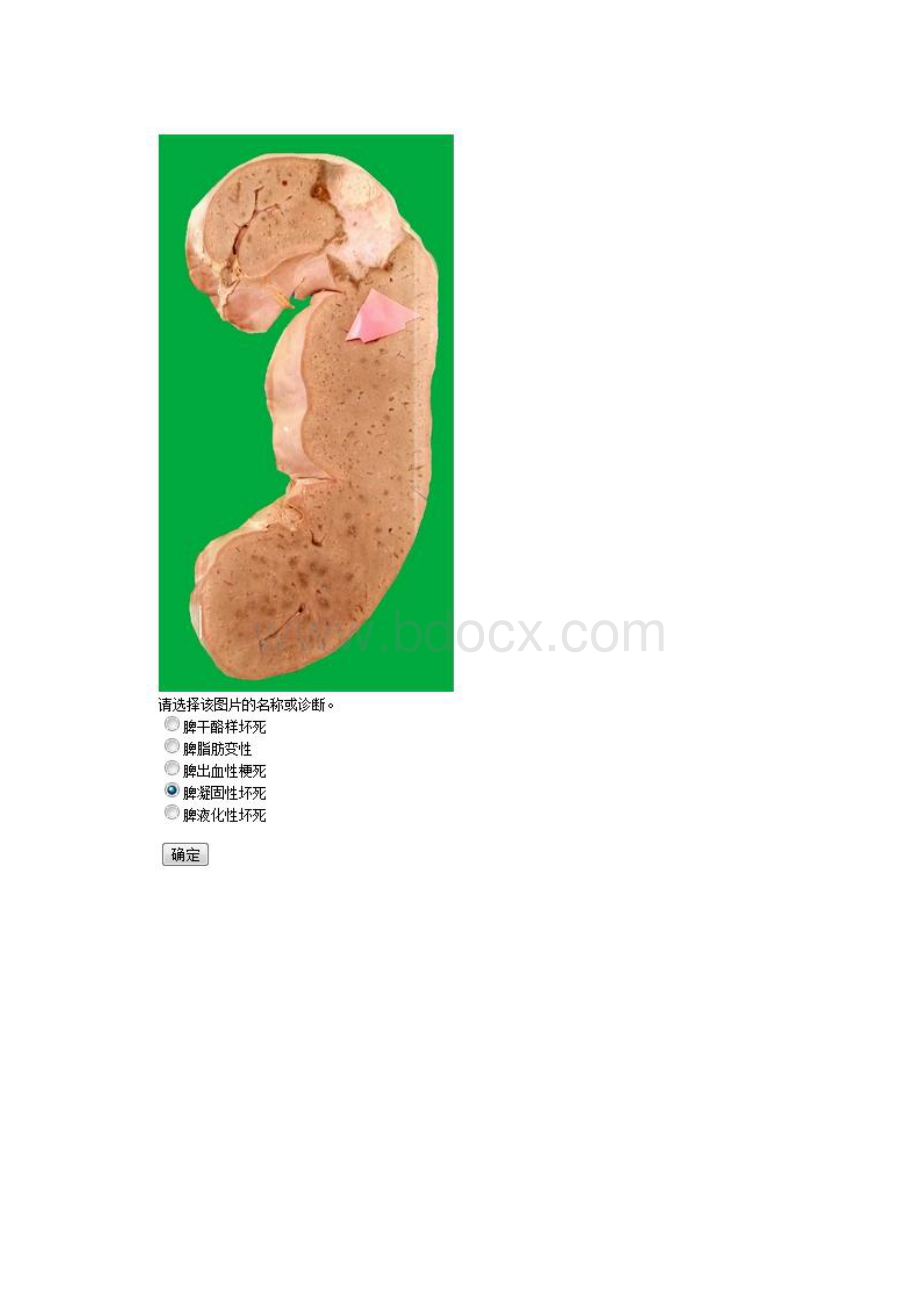 中国医科大学《病理学本科》 实践考试题满分答案.docx_第3页