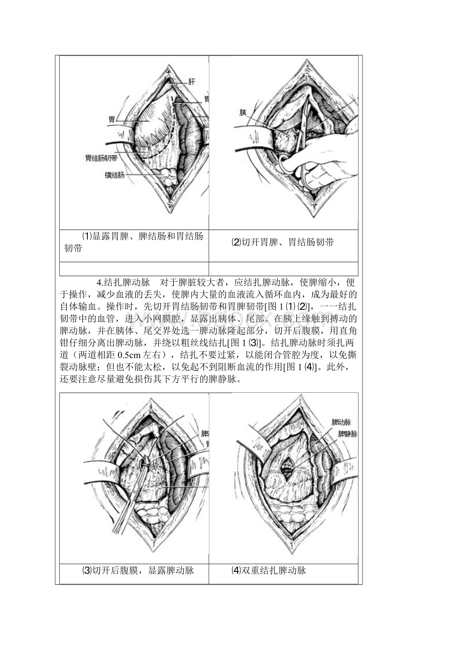 脾切除.docx_第3页