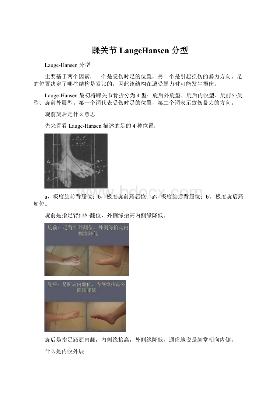 踝关节LaugeHansen 分型.docx