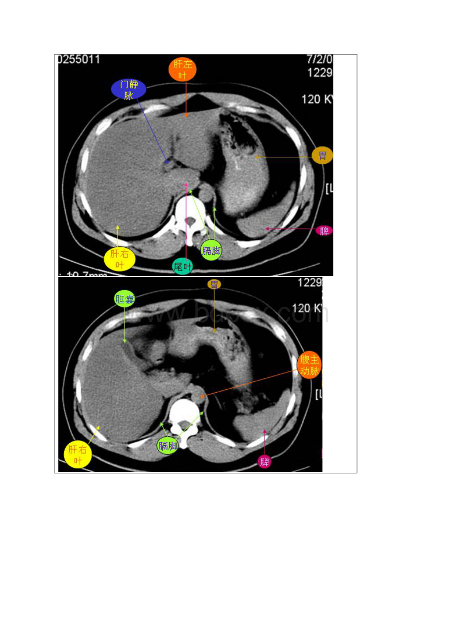 一天学会腹部CT诊断Word文档格式.docx_第3页