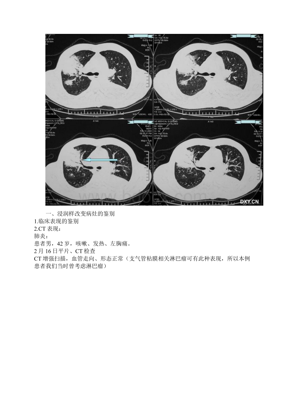 肺炎症结核肿瘤在CT与胸片上区别Word下载.docx_第3页